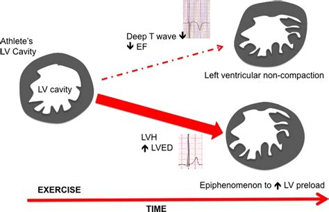 lv trabeculation in athletes